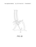 DEVICES AND METHODS FOR FASTENING TISSUE LAYERS diagram and image