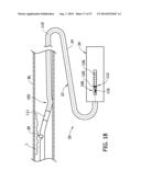 Tissue-Removing Catheter Including Urging Mechanism diagram and image