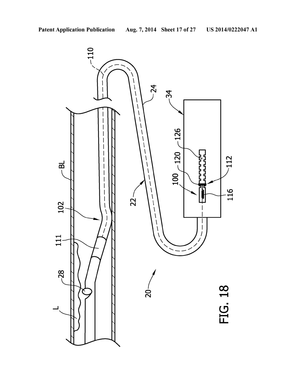 Tissue-Removing Catheter Including Urging Mechanism - diagram, schematic, and image 18