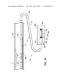 Tissue-Removing Catheter Including Urging Mechanism diagram and image