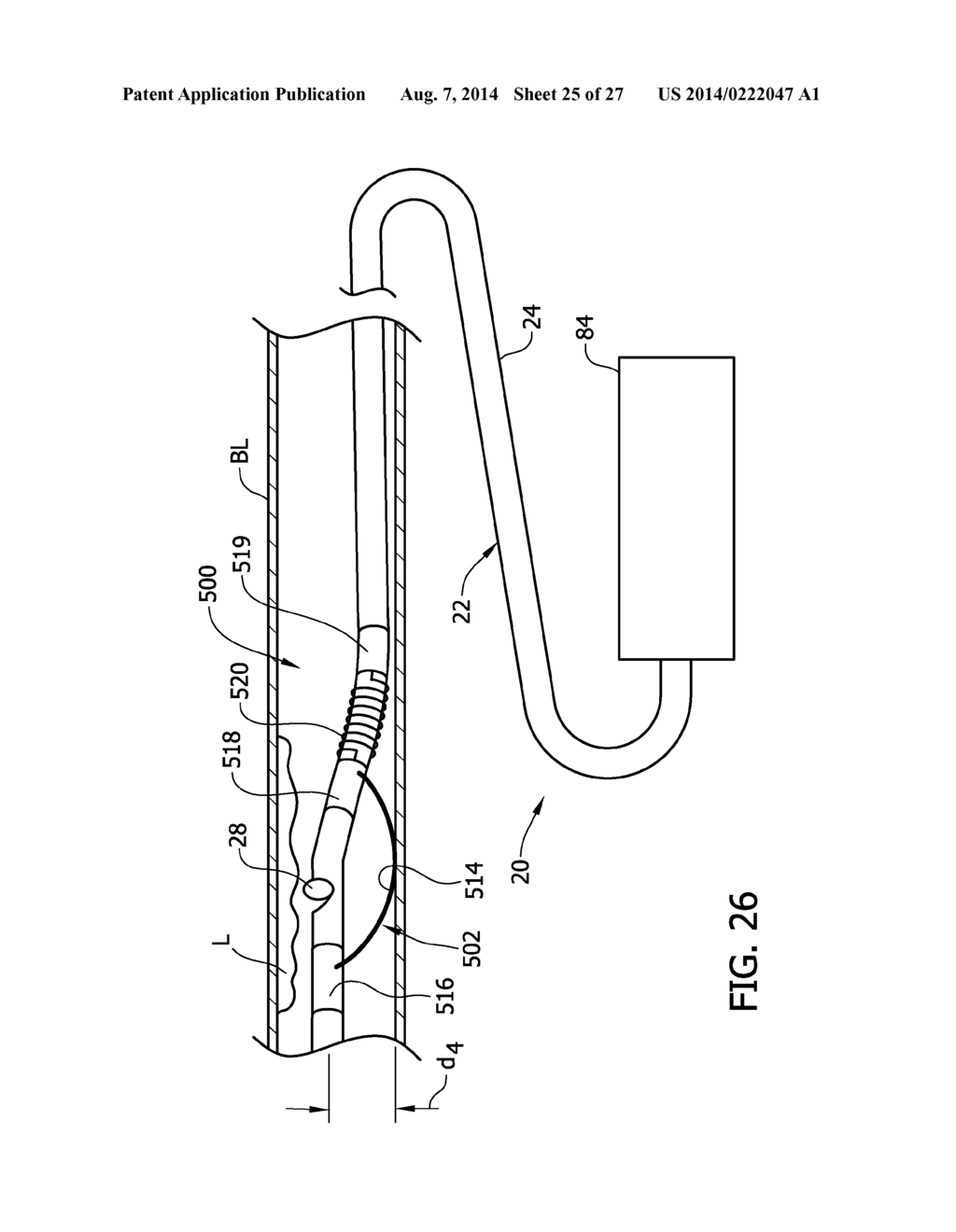 Tissue-Removing Catheter Including Urging Mechanism - diagram, schematic, and image 26