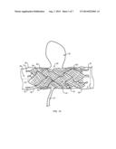 MEDICAL DEVICES INCLUDING METALLIC FILMS AND METHODS FOR MAKING SAME diagram and image