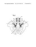 BONE ANCHORING DEVICE diagram and image