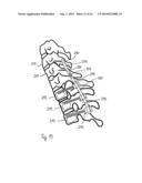 STABILIZATION DEVICE FOR BONES COMPRISING A SPRING ELEMENT AND     MANUFACTURING METHOD FOR SAID SPRING ELEMENT diagram and image