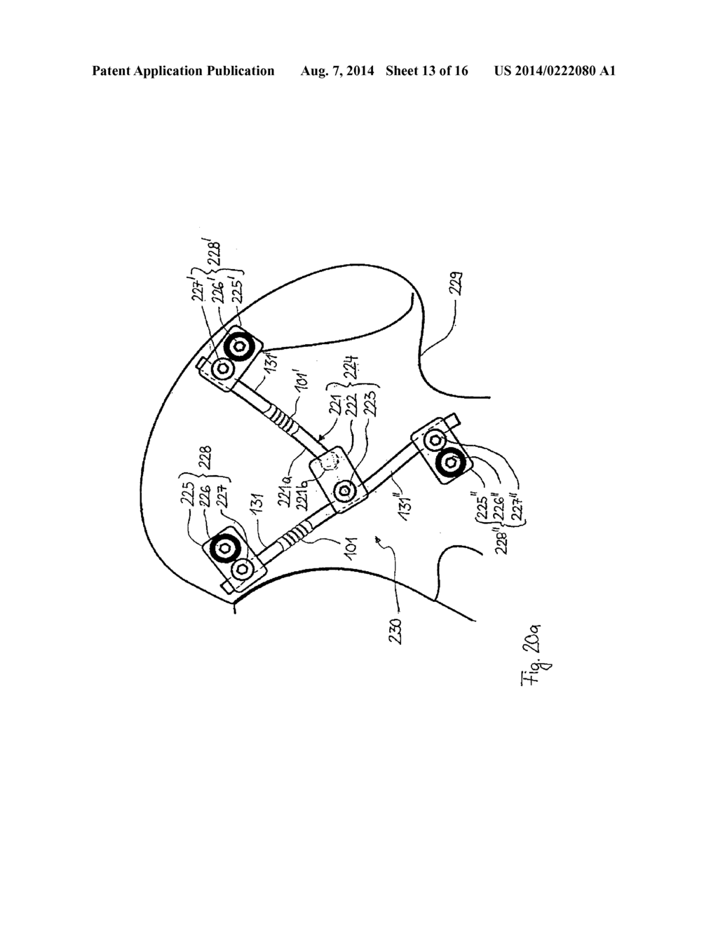 STABILIZATION DEVICE FOR BONES COMPRISING A SPRING ELEMENT AND     MANUFACTURING METHOD FOR SAID SPRING ELEMENT - diagram, schematic, and image 14