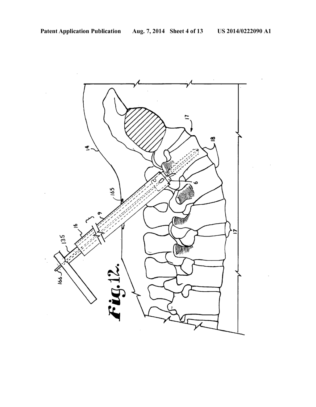 BONE ANCHOR CONFIGURED TO ANCHOR AN ELONGATED IMPLANT TO A PATIENT BONE - diagram, schematic, and image 05