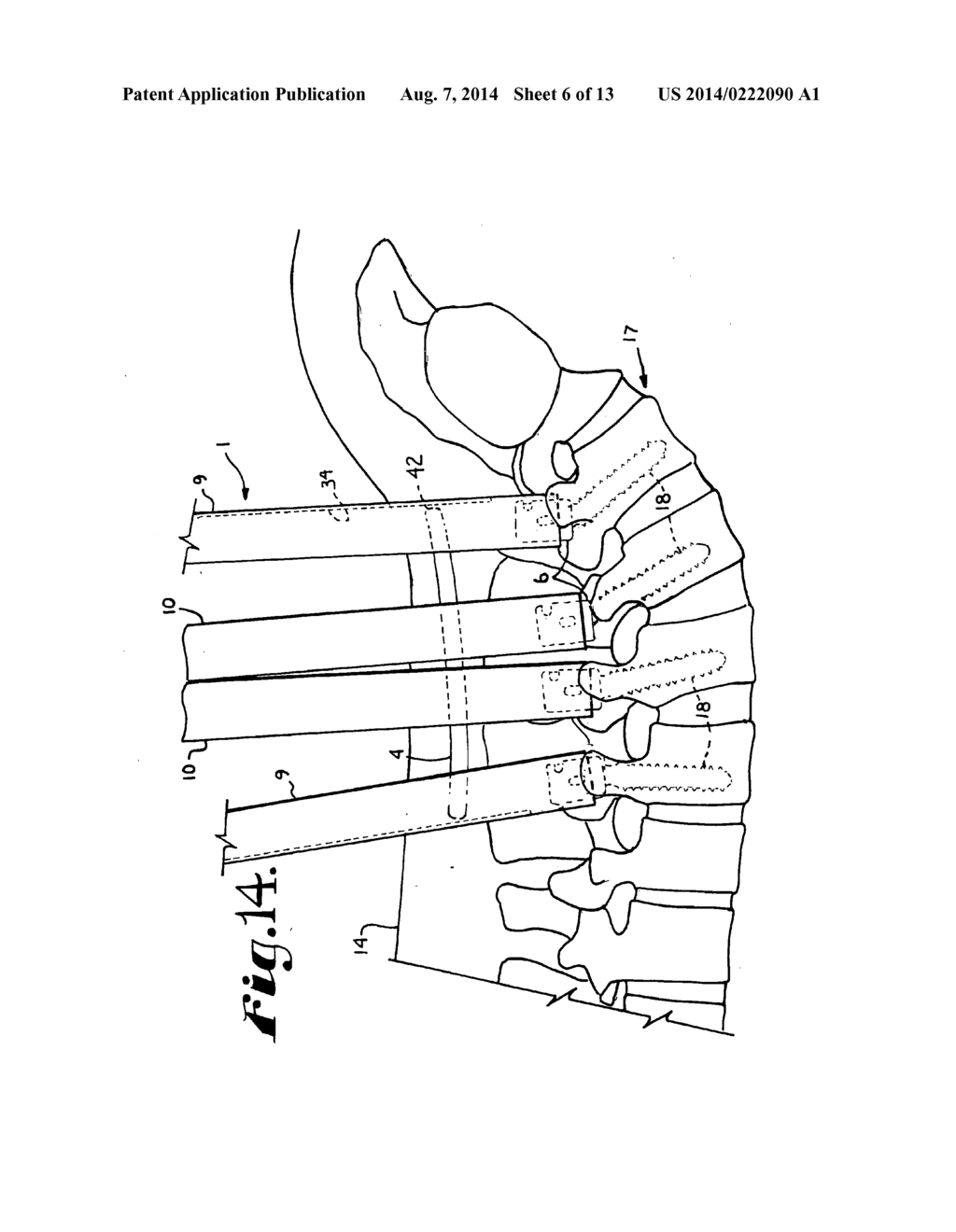 BONE ANCHOR CONFIGURED TO ANCHOR AN ELONGATED IMPLANT TO A PATIENT BONE - diagram, schematic, and image 07
