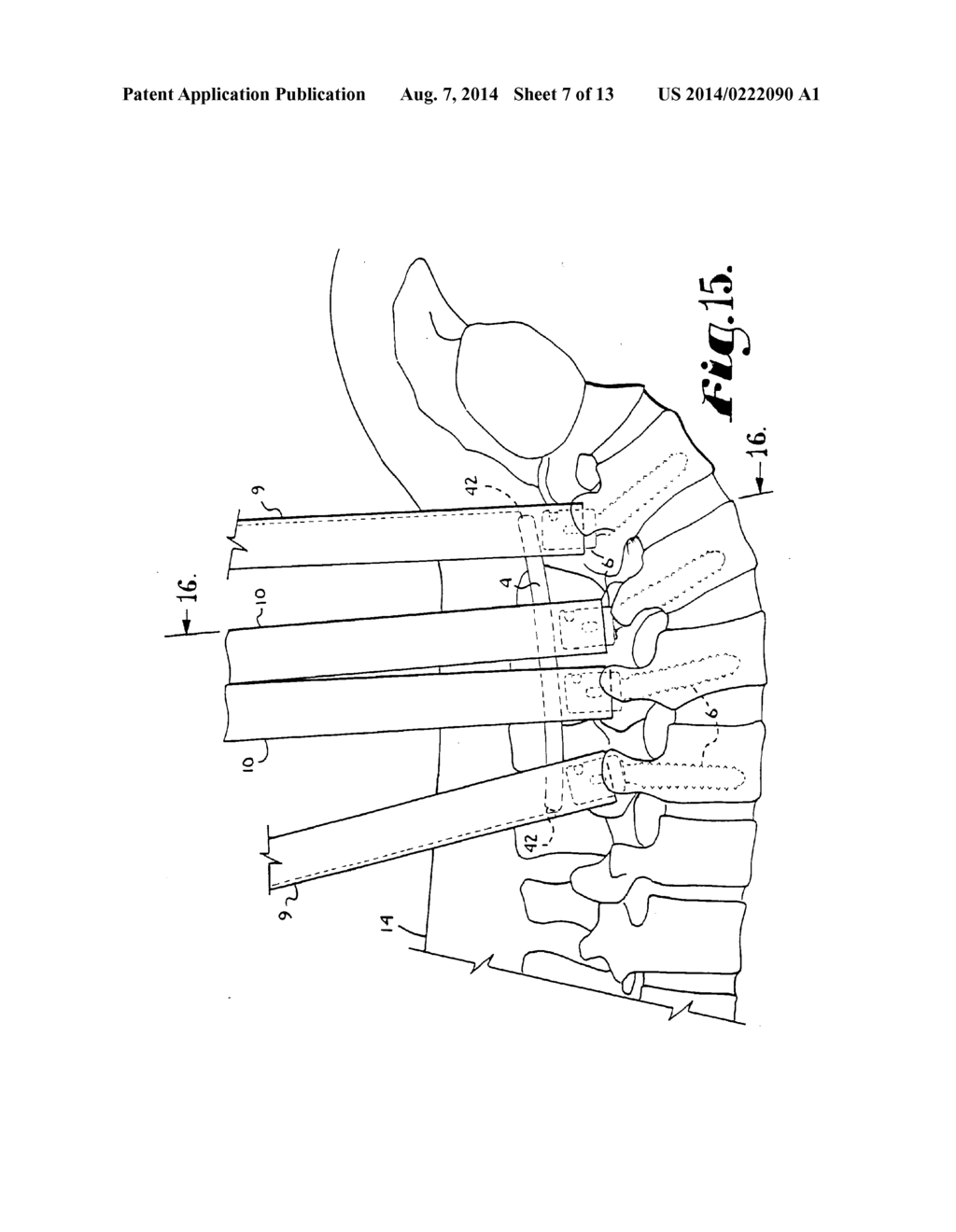 BONE ANCHOR CONFIGURED TO ANCHOR AN ELONGATED IMPLANT TO A PATIENT BONE - diagram, schematic, and image 08