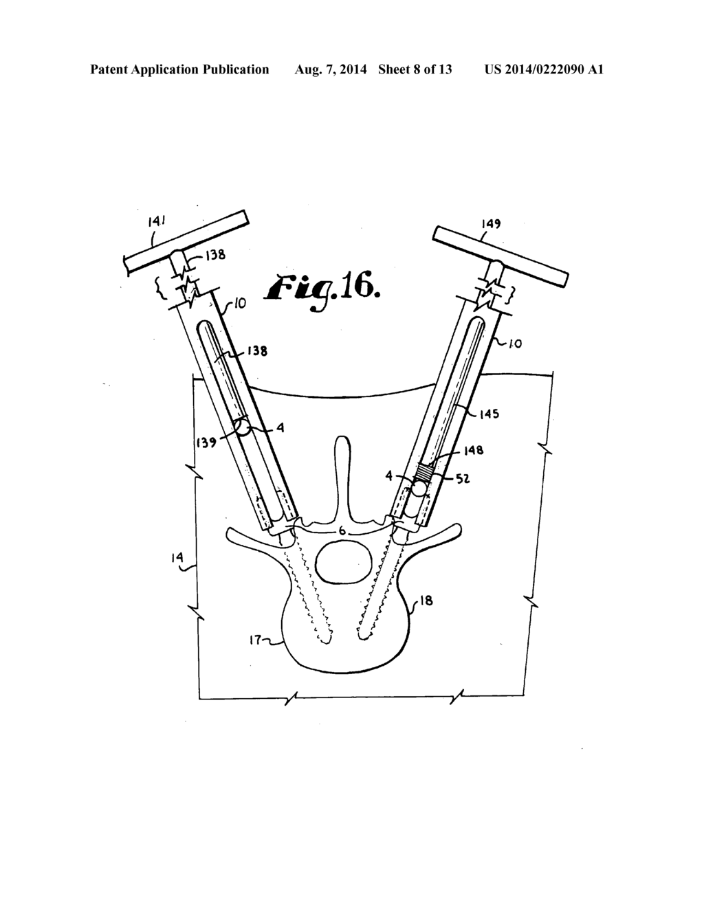 BONE ANCHOR CONFIGURED TO ANCHOR AN ELONGATED IMPLANT TO A PATIENT BONE - diagram, schematic, and image 09