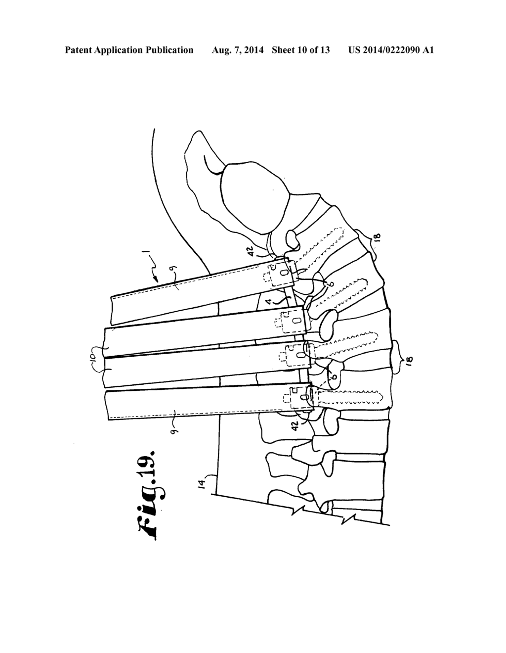 BONE ANCHOR CONFIGURED TO ANCHOR AN ELONGATED IMPLANT TO A PATIENT BONE - diagram, schematic, and image 11