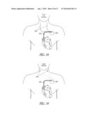 SYSTEMS AND METHODS FOR AVOIDING NEURAL STIMULATION HABITUATION diagram and image