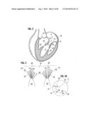 PROSTHETIC VALVE FOR REPLACING MITRAL VALVE diagram and image