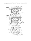 PROSTHETIC VALVE FOR REPLACING MITRAL VALVE diagram and image