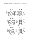 PROSTHETIC VALVE FOR REPLACING MITRAL VALVE diagram and image