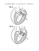 PROSTHETIC VALVE FOR REPLACING MITRAL VALVE diagram and image