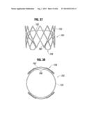 PROSTHETIC VALVE FOR REPLACING MITRAL VALVE diagram and image