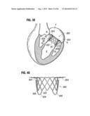 PROSTHETIC VALVE FOR REPLACING MITRAL VALVE diagram and image