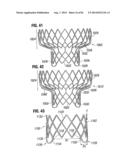 PROSTHETIC VALVE FOR REPLACING MITRAL VALVE diagram and image