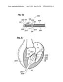 PROSTHETIC VALVE FOR REPLACING MITRAL VALVE diagram and image