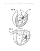 PROSTHETIC VALVE FOR REPLACING MITRAL VALVE diagram and image