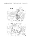 PROSTHETIC VALVE FOR REPLACING MITRAL VALVE diagram and image