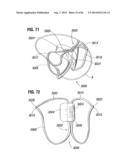 PROSTHETIC VALVE FOR REPLACING MITRAL VALVE diagram and image