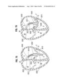 PROSTHETIC VALVE FOR REPLACING MITRAL VALVE diagram and image