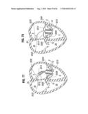 PROSTHETIC VALVE FOR REPLACING MITRAL VALVE diagram and image