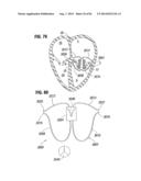 PROSTHETIC VALVE FOR REPLACING MITRAL VALVE diagram and image