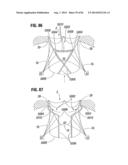 PROSTHETIC VALVE FOR REPLACING MITRAL VALVE diagram and image