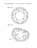 PROSTHETIC VALVE FOR REPLACING MITRAL VALVE diagram and image