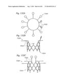 PROSTHETIC VALVE FOR REPLACING MITRAL VALVE diagram and image