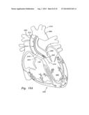 METHODS OF IMPLANTING MINIMALLY-INVASIVE PROSTHETIC HEART VALVES diagram and image