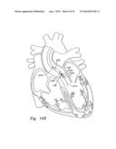 METHODS OF IMPLANTING MINIMALLY-INVASIVE PROSTHETIC HEART VALVES diagram and image