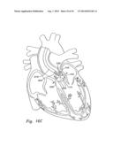 METHODS OF IMPLANTING MINIMALLY-INVASIVE PROSTHETIC HEART VALVES diagram and image