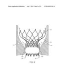 Anti-Paravalvular Leakage Component for a Transcatheter Valve Prosthesis diagram and image