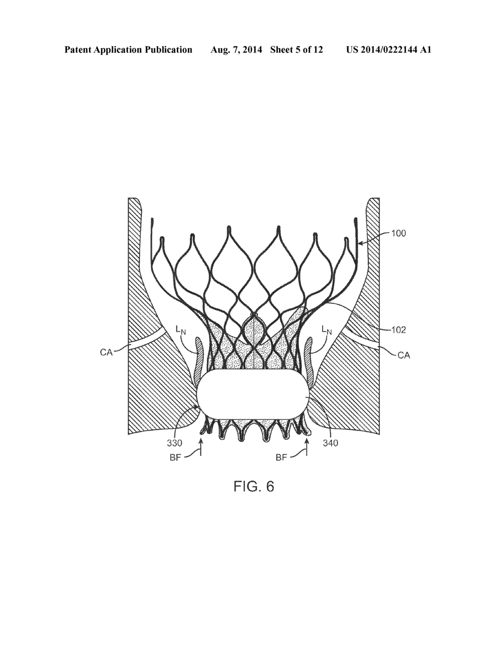 Anti-Paravalvular Leakage Component for a Transcatheter Valve Prosthesis - diagram, schematic, and image 06