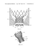 Anti-Paravalvular Leakage Component for a Transcatheter Valve Prosthesis diagram and image