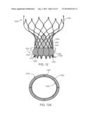 Anti-Paravalvular Leakage Component for a Transcatheter Valve Prosthesis diagram and image