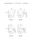 SYSTEMS AND METHODS FOR MASTOPEXY diagram and image