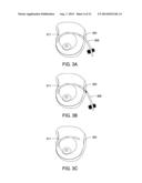 SYSTEMS AND METHODS FOR MASTOPEXY diagram and image