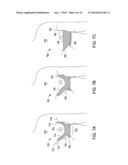 SYSTEMS AND METHODS FOR MASTOPEXY diagram and image