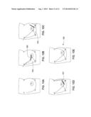 SYSTEMS AND METHODS FOR MASTOPEXY diagram and image