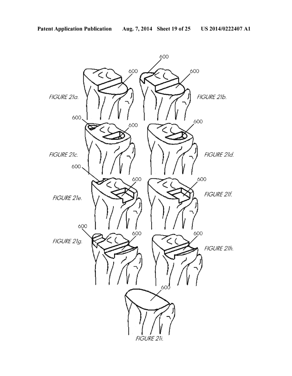 SYSTEMS AND METHODS FOR DETERMINING THE MECHANICAL AXIS OF A FEMUR - diagram, schematic, and image 20