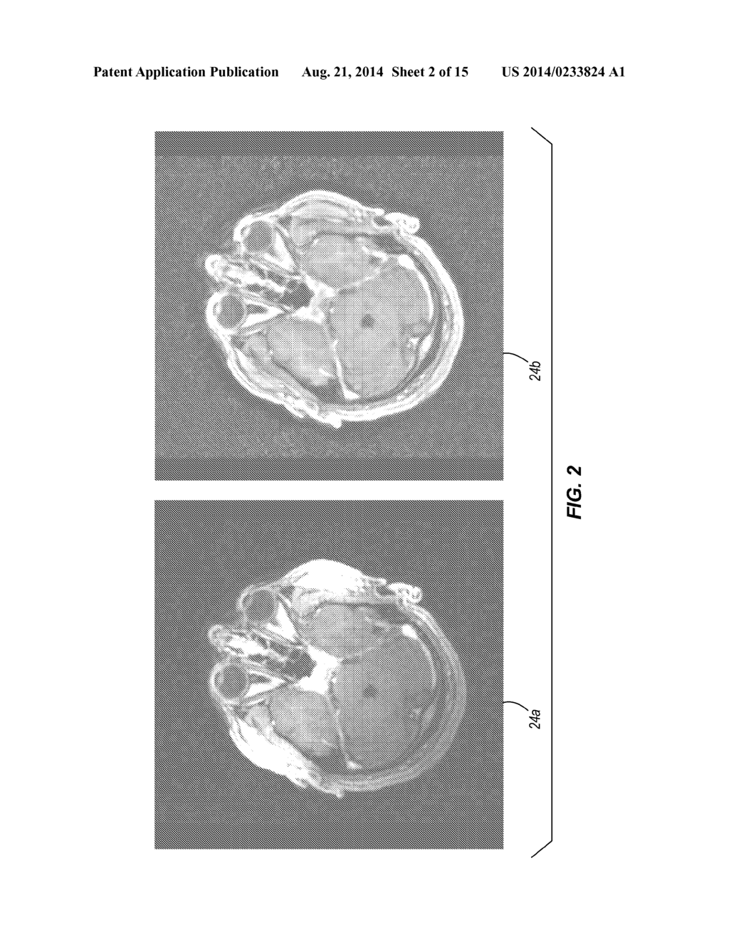 ANTERIOR COMMISSURE AND POSTERIOR COMMISSURE SEGMENTATION SYSTEM AND     METHOD - diagram, schematic, and image 03