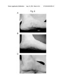 THERAPEUTIC AGENT FOR USE IN A METHOD OF TREATING PSORIASIS OR ATOPIC     DERMATITIS diagram and image