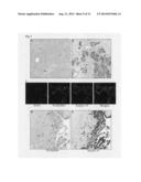 Tumor biomarkers for pancreatic marker diagram and image