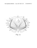 MINIMALLY INVASIVE LEVATOR AVULSION REPAIR diagram and image