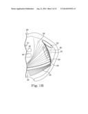 MINIMALLY INVASIVE LEVATOR AVULSION REPAIR diagram and image