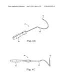 MINIMALLY INVASIVE LEVATOR AVULSION REPAIR diagram and image